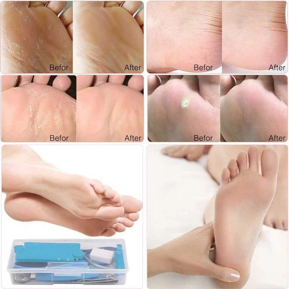 10Pcs Callous Remover Pedicure Tool Set
